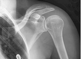 shoulder impingement x-ray