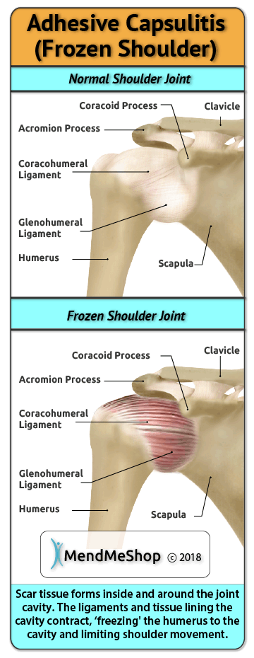Scar tissue builds up throughout the 3 stages of a frozen shoulder injury.