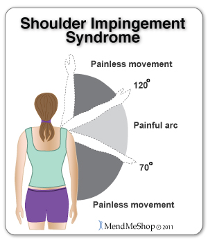 Shoulder Impingement Syndrome causes a painful arc between 70°  and 120° . Treating the swelling and inflammation early can reduce the risk of bursitis, tendinitis, bone spurs, and calcification of the tendon.