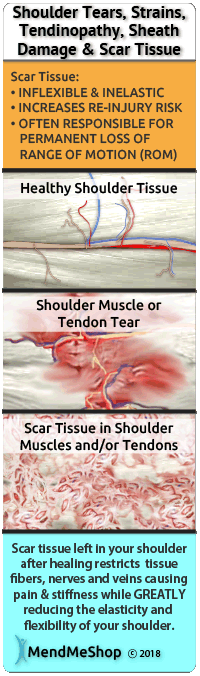 Frozen shoulder scar tissue brittle is inflexible stiff painful