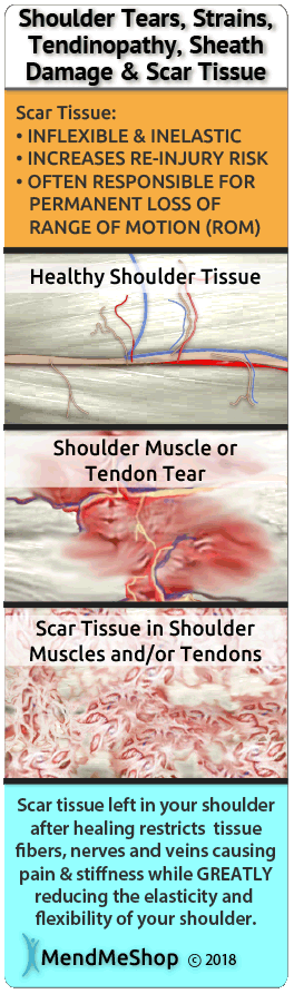 shoulder space narrows causes shoulder impingement