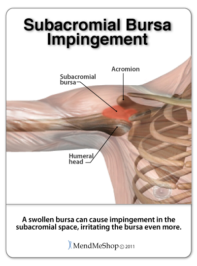 shoulder impingement subacromial bursitis